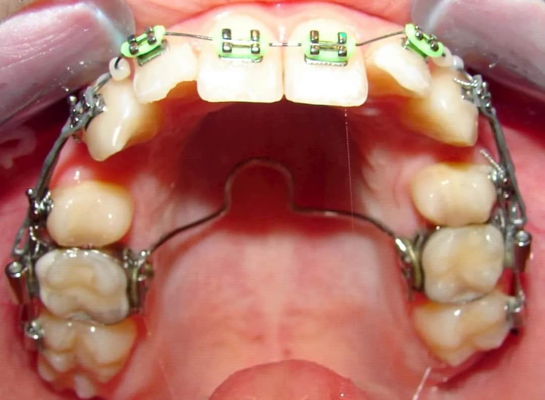 Jak bezpiecznie przekręcać aparat Hassa bez ryzyka uszkodzenia i utraty gwarancji